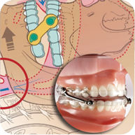TMJ & Sleep Apnea