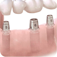 Dental Implants